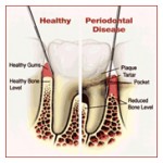 gum-disease-pic1-150x150